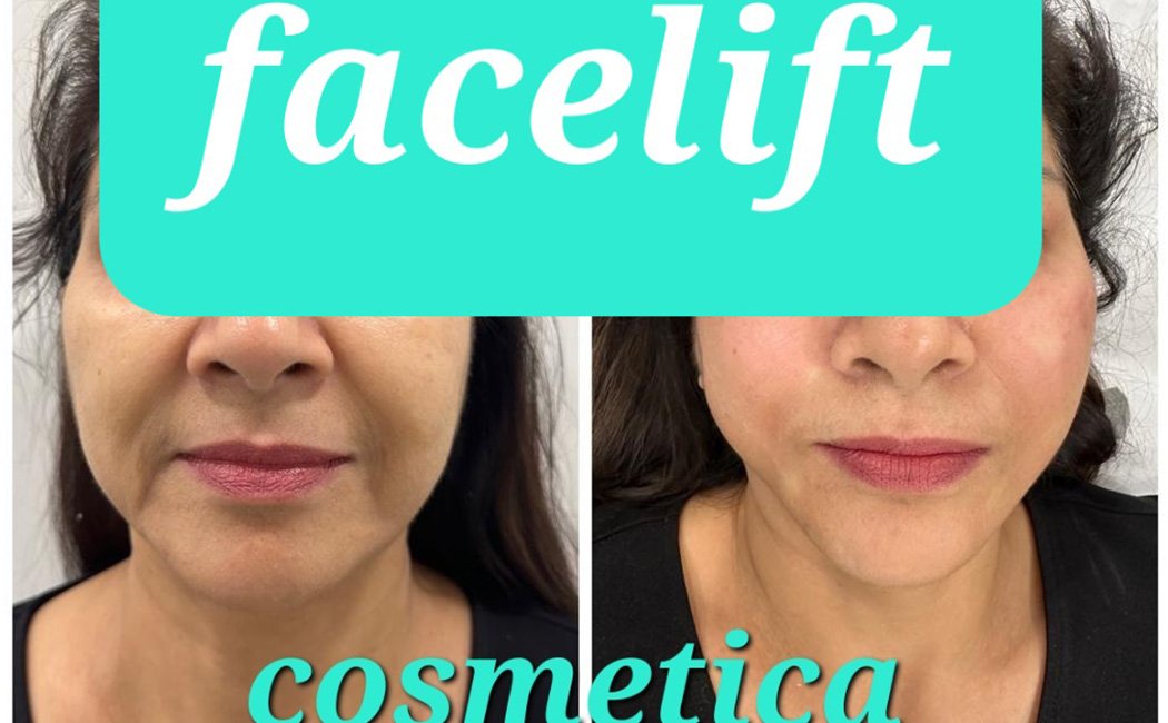 Face Lifting and Tightening