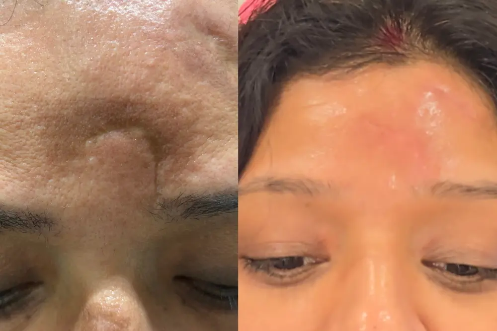 Facial Scar Revision Surgery
